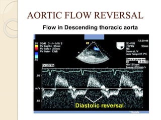 AORTIC FLOW REVERSAL
 