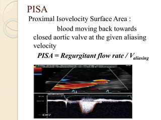 PISA
Proximal Isovelocity Surface Area :
blood moving back towards
closed aortic valve at the given aliasing
velocity
PISA = Regurgitant flow rate / Valiasing
 