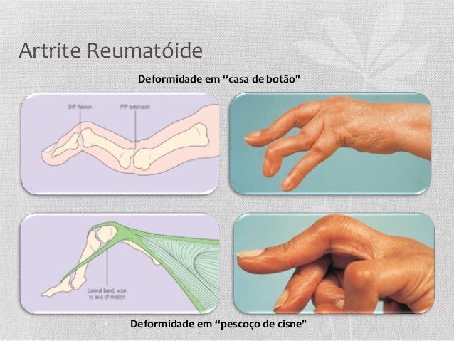 Exames para detectar artrite reumatoide