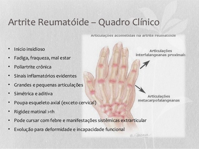 Exames para detectar artrite reumatoide