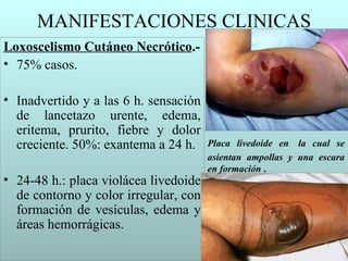 MANIFESTACIONES CLINICAS
Loxoscelismo Cutáneo Necrótico.-
• 75% casos.

• Inadvertido y a las 6 h. sensación
  de lancetazo urente, edema,
  eritema, prurito, fiebre y dolor
  creciente. 50%: exantema a 24 h.     Placa livedoide en la cual se
                                       asientan ampollas y una escara
                                       en formación .
• 24-48 h.: placa violácea livedoide
  de contorno y color irregular, con
  formación de vesículas, edema y
  áreas hemorrágicas.
 