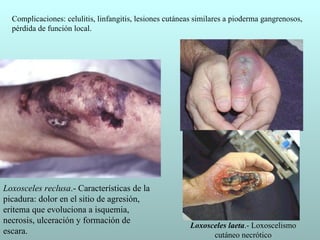 Complicaciones: celulitis, linfangitis, lesiones cutáneas similares a pioderma gangrenosos,
  pérdida de función local.




Loxosceles reclusa.- Características de la
picadura: dolor en el sitio de agresión,
eritema que evoluciona a isquemia,
necrosis, ulceración y formación de
                                                         Loxosceles laeta.- Loxoscelismo
escara.                                                        cutáneo necrótico
 