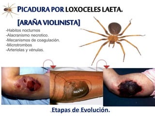 PICADURAPORLOXOCELESLAETA.
[ARAÑAVIOLINISTA]
-Habitos nocturnos
-Alacranismo necrotico.
-Mecanismos de coagulación.
-Microtrombos
-Arteriolas y vénulas.
Etapas de Evolución.
 