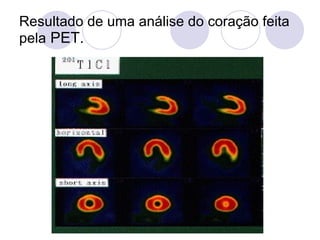 Resultado de uma análise do coração feita pela  PET. 