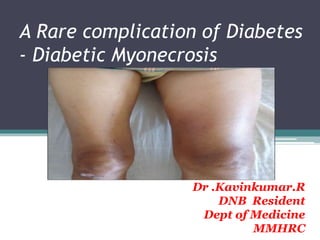 A Rare complication of Diabetes
- Diabetic Myonecrosis
Dr .Kavinkumar.R
DNB Resident
Dept of Medicine
MMHRC
 