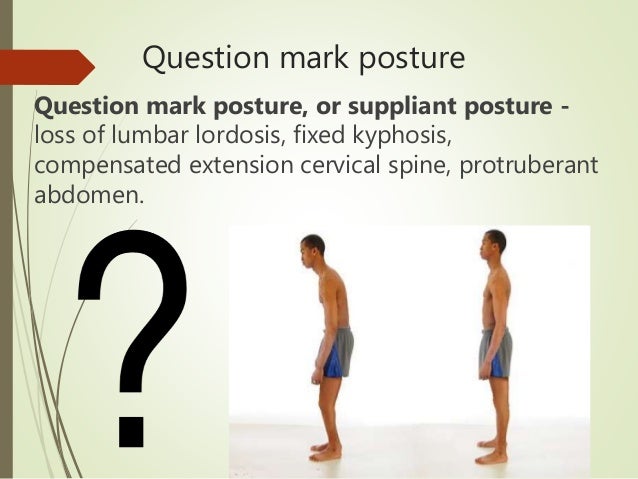 ANKYLOSING SPONDYLITIS physiotherapy ppt