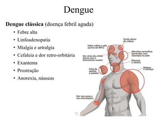Dengue
Dengue clássica (doença febril aguda)
• Febre alta
• Linfoadenopatia
• Mialgia e artralgia
• Cefaleia e dor retro-orbitária
• Exantema
• Prostração
• Anorexia, náuseas
 