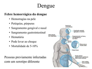 Dengue
Febre hemorrágica da dengue
• Hemorragias na pele
• Petéquias, púrpuras
• Sangramento gengival e nasal
• Sangramento gastrointestinal
• Hematúria
• Pode levar ao choque
• Mortalidade de 5-10%
Pessoas previamente infectadas
com um sorotipo diferente
 
