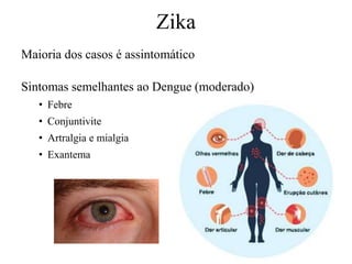 Maioria dos casos é assintomático
Sintomas semelhantes ao Dengue (moderado)
• Febre
• Conjuntivite
• Artralgia e mialgia
• Exantema
Zika
 