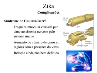 Síndrome de Guillain-Barré
Fraqueza muscular causada por
dano ao sistema nervoso pelo
sistema imune
Aumento de número de casos em
regiões com a presença do vírus
Relação ainda não bem definida
Zika
Complicações
 