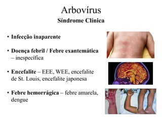 Arbovírus
Síndrome Clínica
• Infecção inaparente
• Doença febril / Febre exantemática
– inespecífica
• Encefalite – EEE, WEE, encefalite
de St. Louis, encefalite japonesa
• Febre hemorrágica – febre amarela,
dengue
 