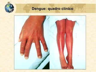 Dengue: quadro clínico
 