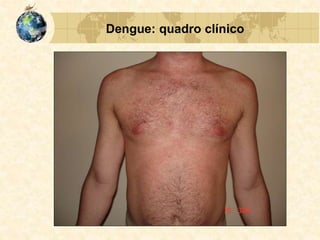 Dengue: quadro clínico
 