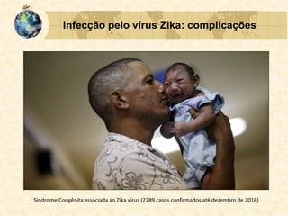 Infecção pelo vírus Zika: complicações
Síndrome Congênita associada ao Zika vírus (2289 casos confirmados até dezembro de 2016)
 