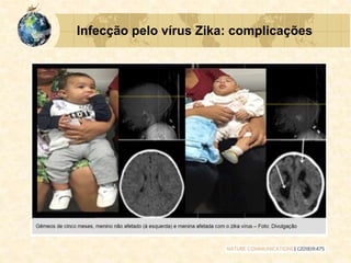 Infecção pelo vírus Zika: complicações
 