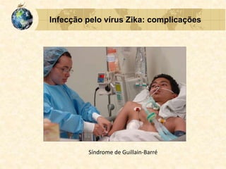 Infecção pelo vírus Zika: complicações
Síndrome de Guillain-Barré
 