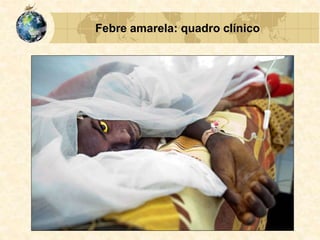 Febre amarela: quadro clínico
 