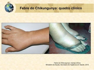 Febre do Chikungunya: quadro clínico
Febre do Chikungunya: manejo clínico
Ministério da Saúde, Secretaria de Vigilância em Saúde, 2015
 