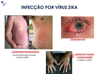 EXANTEMAPRURIGINOSO
Secretaria Municipal de Saúde
de SãoLuís/MA
CONJUNTIVITE
EDEMA DE PUNHO
E DEDOS MAÕS
Dr Kleber Luz (RN)
INFECÇÃO POR VÍRUS ZIKA
 