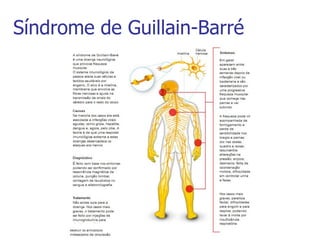 Síndrome de Guillain-Barré
 