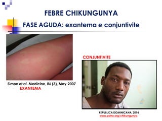 MarionBurger 03/março/2016
REPUBLICA DOMINICANA, 2014
www.paho.org/chikungunya
CONJUNTIVITE
Simon et al. Medicine, 86 (3), May 2007
EXANTEMA
FEBRE CHIKUNGUNYA
FASE AGUDA: exantema e conjuntivite
 