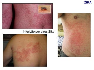 Infecção por vírus Zika
ZIKA
 
