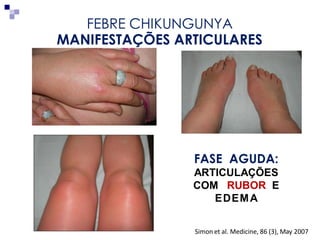 MarionBurger 03/março/2016
Simon et al. Medicine, 86 (3), May 2007
MANIFESTAÇÕES ARTICULARES
FASE AGUDA:
ARTICULAÇÕES
COM RUBOR E
EDEMA
FEBRE CHIKUNGUNYA
 
