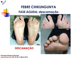 DESCAMAÇÃO
Emerging Infectious Diseases
www.cdc.gov/eid • Vol. 18, No. 3, March 2012
FEBRE CHIKUNGUNYA
FASE AGUDA: descamação
 