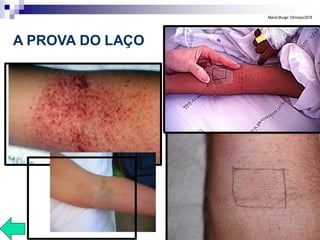 VIROSES
EMERGENT
ES
MarionBurger 03/março/2016
A PROVA DO LAÇO
 