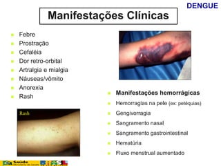  Manifestações hemorrágicas
 Hemorragias na pele (ex: petéquias)
 Gengivorragia
 Sangramento nasal
 Sangramento gastrointestinal
 Hematúria
 Fluxo menstrual aumentado
 Febre
 Prostração
 Cefaléia
 Dor retro-orbital
 Artralgia e mialgia
 Náuseas/vômito
 Anorexia
 Rash
Rash
Manifestações Clínicas
DENGUE
 