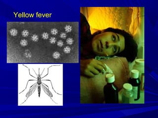 Yellow fever
 