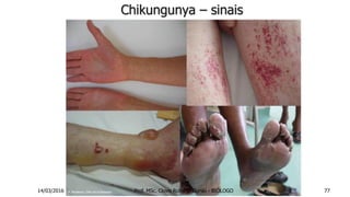 Chikungunya – sinais
14/03/2016 Prof. MSc. Clovis Roberto Gurski - BIÓLOGO 77
 