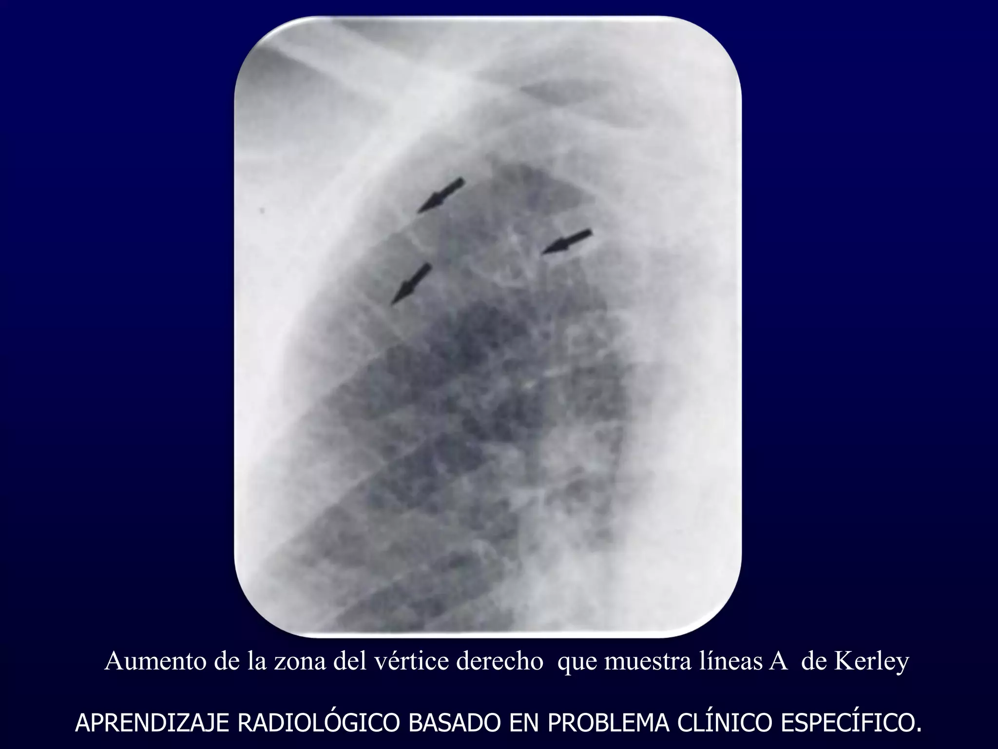 ARBPCE 2014 Lineas de Kerley PPT