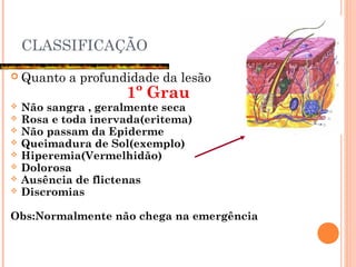 CLASSIFICAÇÃO
 Quanto a profundidade da lesão
1º Grau
 Não sangra , geralmente seca
 Rosa e toda inervada(eritema)
 Não passam da Epiderme
 Queimadura de Sol(exemplo)
 Hiperemia(Vermelhidão)
 Dolorosa
 Ausência de flictenas
 Discromias
Obs:Normalmente não chega na emergência
 