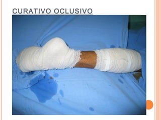CURATIVO OCLUSIVO
 