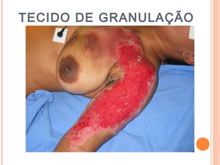 TECIDO DE GRANULAÇÃO
 
