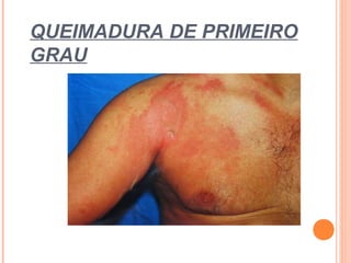 QUEIMADURA DE PRIMEIRO
GRAU
 