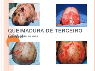 QUEIMADURA DE TERCEIRO
GRAUEnxertia de pele
 