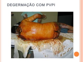 DEGERMAÇÃO COM PVPI
 