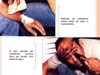 O olho atingido por
substância química
deve ser lavado com
bastante água.
Retirada da substância
sólida antes de lavar o
local afetado.
 