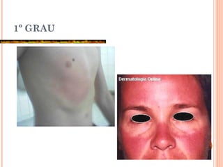 1º GRAU
 