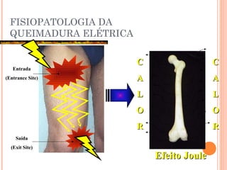 FISIOPATOLOGIA DA
QUEIMADURA ELÉTRICA
Entrada
(Entrance Site)
Saída
(Exit Site)
CC
AA
LL
OO
RR
CC
AA
LL
OO
RR
Efeito JouleEfeito Joule
 