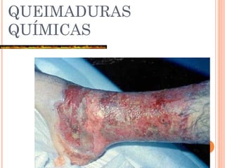 QUEIMADURAS
QUÍMICAS
 