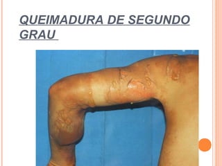 QUEIMADURA DE SEGUNDO
GRAU
 