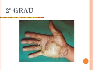 2º GRAU
 