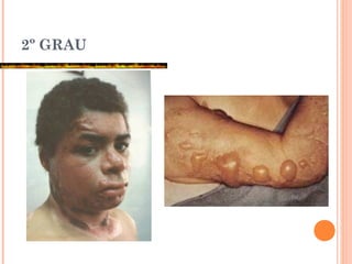 2º GRAU
 