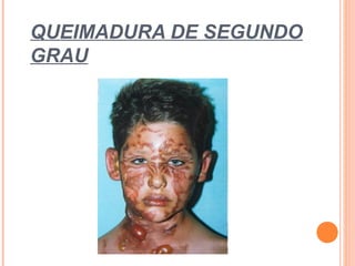 QUEIMADURA DE SEGUNDO
GRAU
 