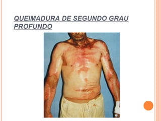 QUEIMADURA DE SEGUNDO GRAU
PROFUNDO
 