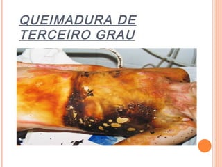 QUEIMADURA DE
TERCEIRO GRAU
 