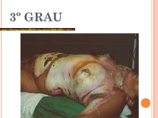 3º GRAU
 